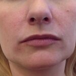 Bruzdy nosowo-wargowe przed i po zabiegu