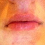Usta przed i po zabiegu kwasem hialuronowym