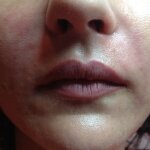 Bruzdy nosowo-wargowe przed i po zabiegu kwasem hialuronowym