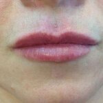 Usta dojrzałej kobiety przed i po zabiegu kwasem hailuronowym