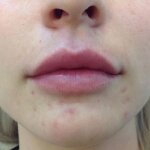 Usta przed i po zabiegu kwasem hialuronowym
